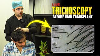 How Trichoscopy Is Done | Scalp Examination Before Hair Transplant by Dr. Prakash Khute