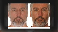 Rhinoplasty San Francisco Fixing a Crooked Nose