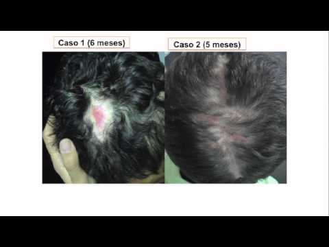 Vídeo: Dermatofibrosarcoma Protuberans - O Uso De Imatinibe Neoadjuvante No Tratamento De Uma Neoplasia Maligna Incomum Da Mama: Relato De Caso