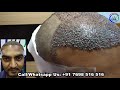 Live Hair Transplant Surgery || Dense Hair Transplantation || Best Hair Transplant Clinic in India