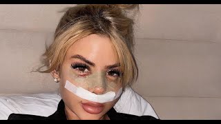 Love Island's Hannah Elizabeth reveals the results of nose job after Turkey trip