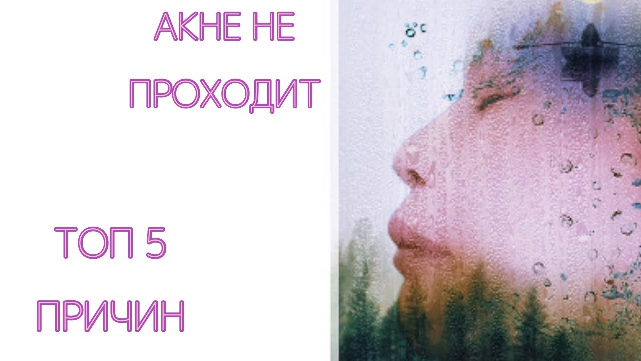 #акне Топ 5 причин акне. Не проходят годами. Прыщи. Лечение прыщей.