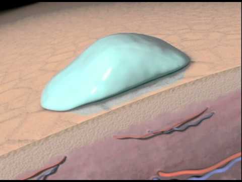The Science behind Personal Microderm and microdermabrasion with animation.