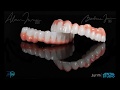 Cindee&#39;s New Smile with ZirPeek from Jurim Dental Studio