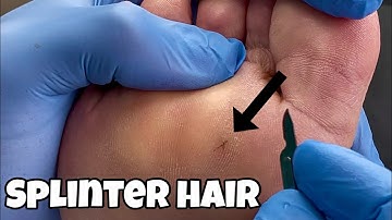 Painful Hair Splinter Removal 😱