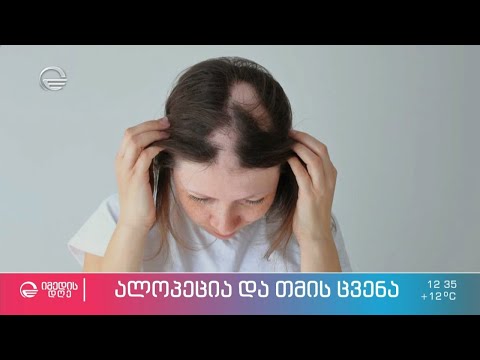 ალოპეცია და თმის ცვენა - შესაძლებელია თუ არა თმის ცვენის შეჩერება?