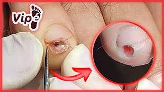 PODOLOGIA EM UNHA ENCRAVADA (OVERGROWN INFECTED INGROWN TOENAIL REMOVAL)