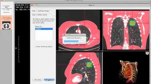 Using MiaPlugin for OsiriX & Lung tumor segmentation