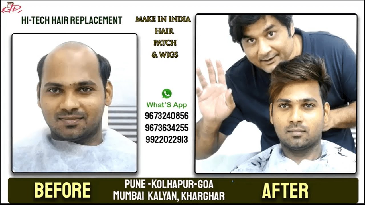 Prem Hair Expert LYNX Pune  Hair Patch in Pune