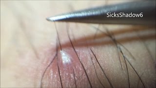 予想以上に長い埋没毛引っこ抜いて膿出ししてみた Remove Ingrown Hair Pus Youtube