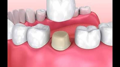 Multilink N - how to cement an E-max crown
