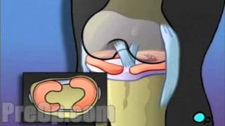 Arthroscopic Meniscus Repair of Knee Medical Surgery  Patient Education