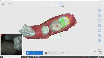 Scanning Peek Scan Body by Runyes IOS-11
