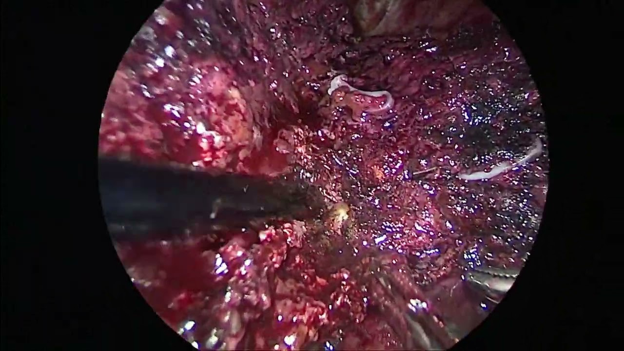 Pure Laparoscopic Right Hepatectomy,   Samsung Medical Center technique