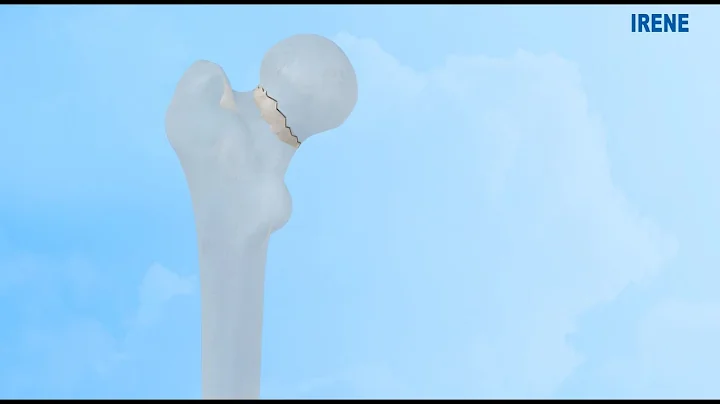 Femoral Neck System (FNS)