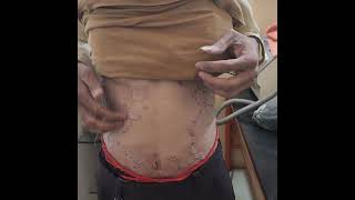 Case of Psoriasis dr Bhutada Skin India