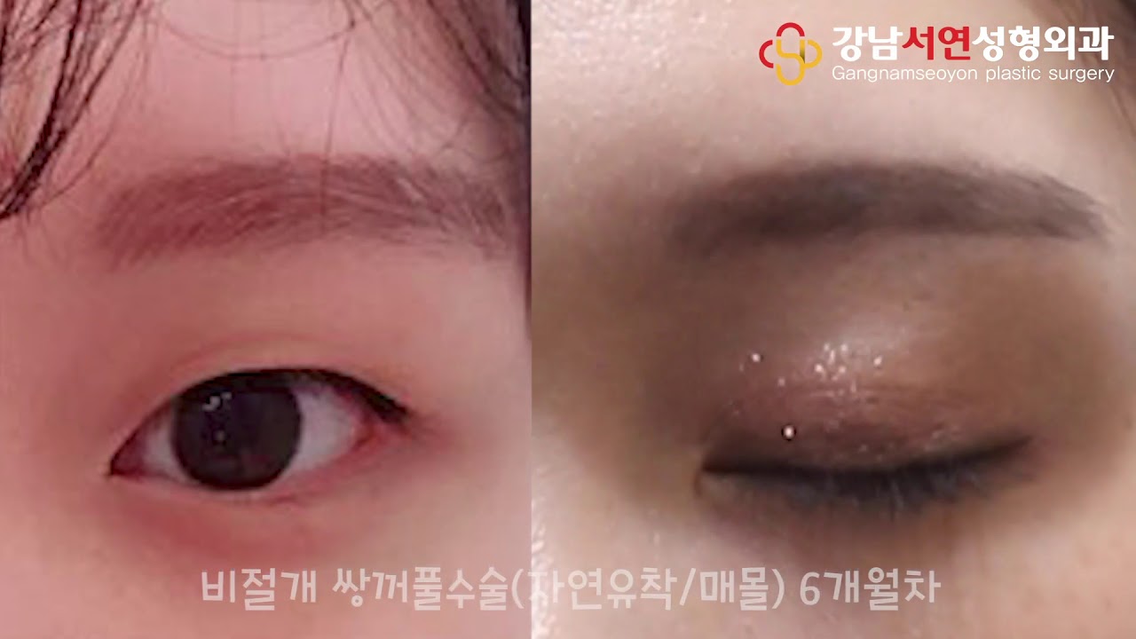 [Thẩm mỹ viện Gangnam Seoyeon] Nếp mí đôi của nữ tại Thẩm mỹ viện Gangnam Seoyeon (dính tự nhiên/chôn) Hãy so sánh đường mí đôi khi bạn mở và nhắm mắt~