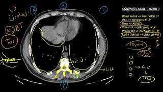 Abdomen BT Yorumlama