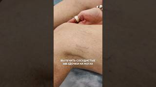 ВЫЛЕЧИТЬ СОСУДИСТЫЕ ЗВЕЗДОЧКИ НА НОГАХ ЗА 1 ПРОЦЕДУРУ #варикоз #клиника #здоровье
