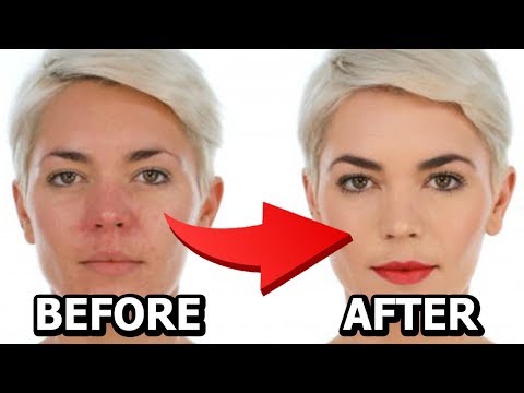 How to Treat Rosacea Naturally || Top  Home Remedies for Rosacea