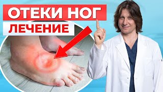 Что делать, если отекают ноги? 5 причин и способы лечения отека ног