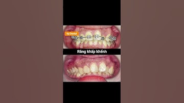 Cận cảnh quá trình niềng răng khấp khểnh tại Up Dental