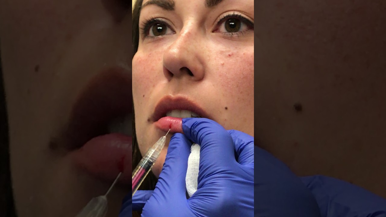 Volbella for the lips in Denver