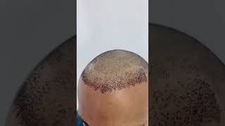 زراعة الشعر في مركز Change Me