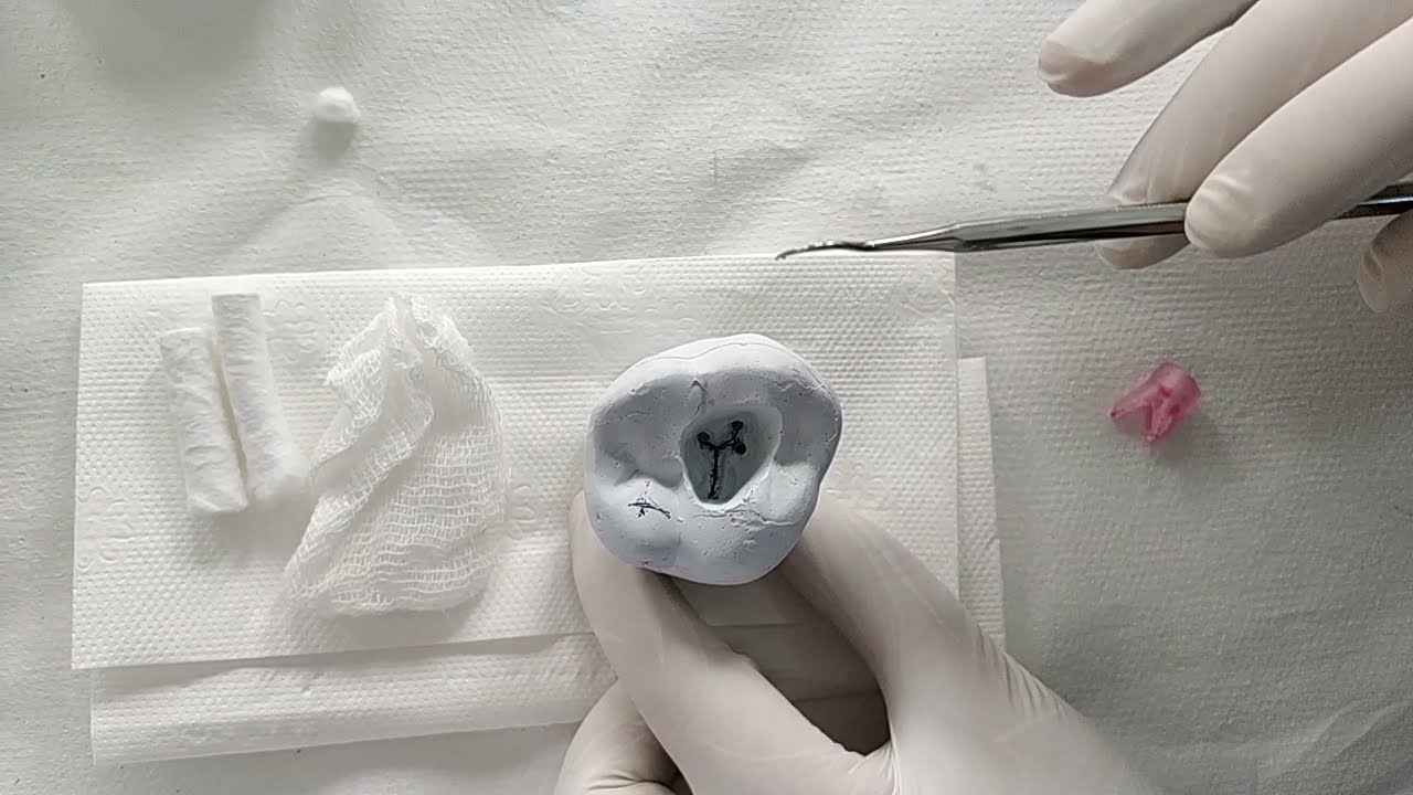 Üst molar dişte endodontik preparasyon ve kalsiyum hidroksit medikasyonu