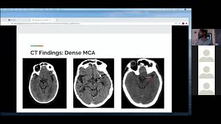 Dr  Neupane   Malignant MCA Syndrome
