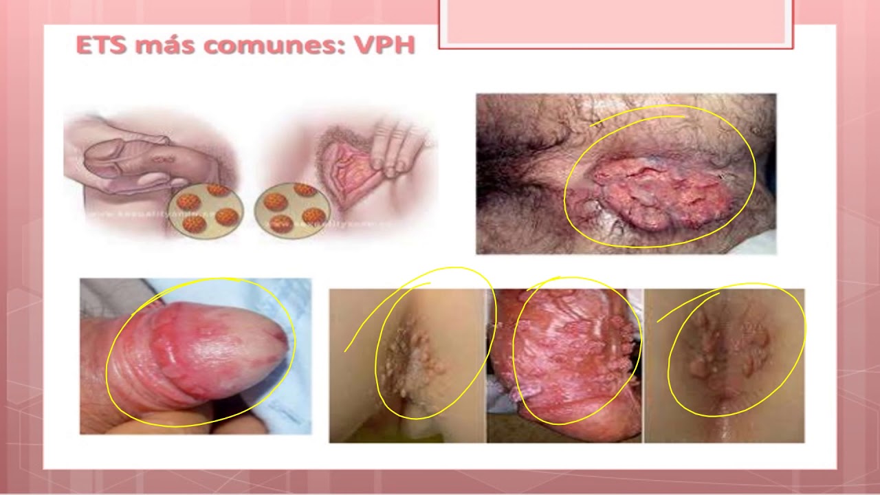 Download ITS de origen viral VHP, VIH, VHB, VHS 2