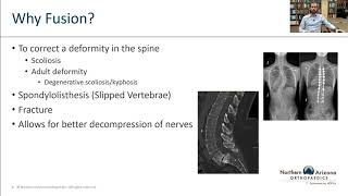 Spinal Fusion: Separating Myths from Facts w/ Dr. Eamonn Mahoney | Northern Arizona Orthopaedics