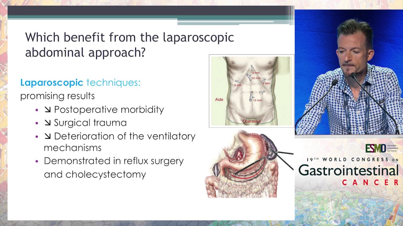 Minimally invasive surgery for cancer of the esophagus YouTube