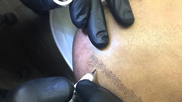 Warning/Scalp Micropigmentation Center can change your Life by Tino Barbone