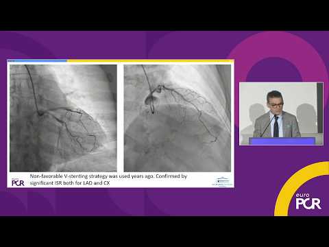 DCB: does coating morphology matter for distal embolisation and clinical outcomes? - EuroPCR 2026