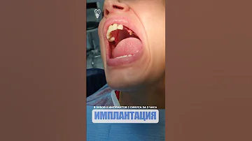 8 зубов 6 имплантов 2 синуса за 3 часа. 8 teeth 6 implants 2 sinuses in 3 hours.