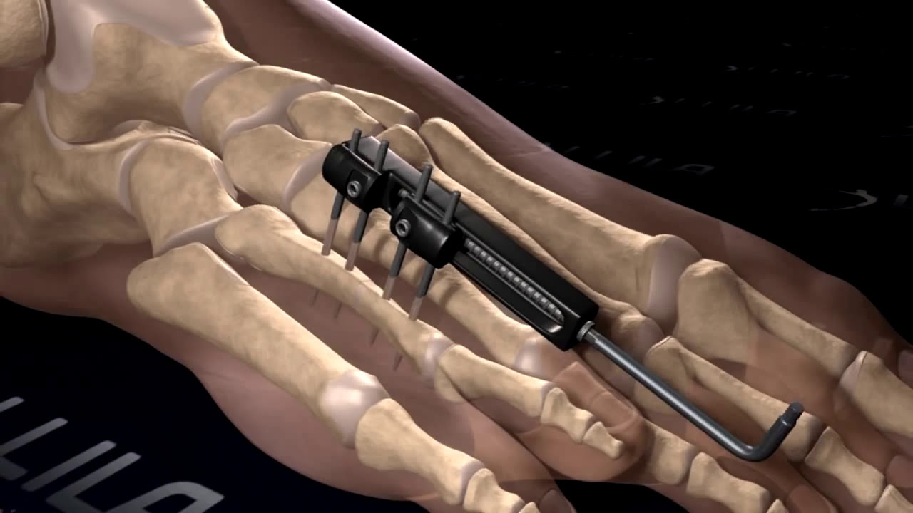 Discover the Revolutionary Brachymetatarsia Surgery Method - YouTube