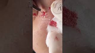 Acne treatment Mai Ngọc
