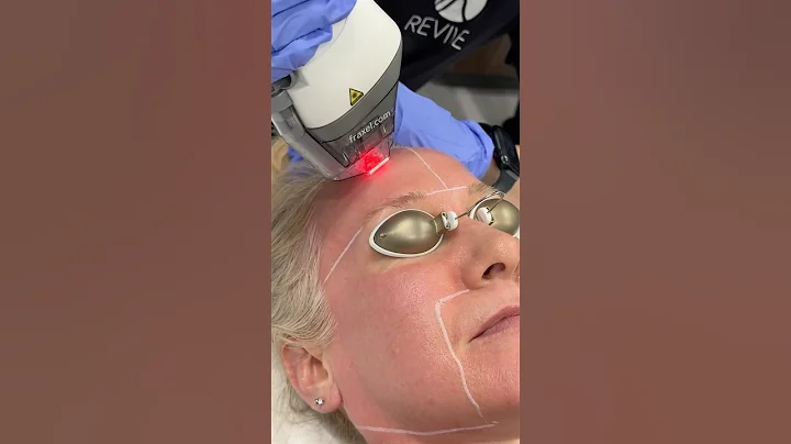 Fraxel 1550/1927 anti-aging + skin resurfacing