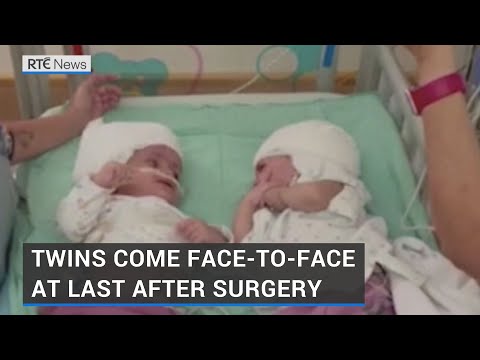 Separation surgery sees twins come face to face at last