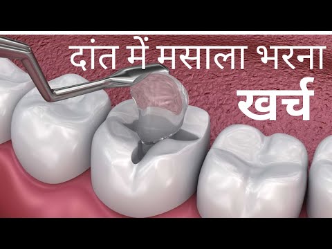 वीडियो: कैविटी क्लोजर कहाँ जाते हैं?