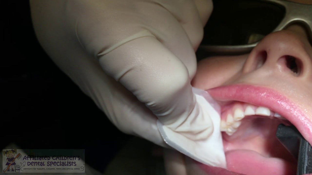 SDF SMART Filling Tutorial; Silver Diamine Fluoride + Glass Ionomer Cement