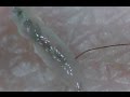 #11 超スッキリ！毛根鞘を引っこ抜き！(Pull out hair root & root sheath)