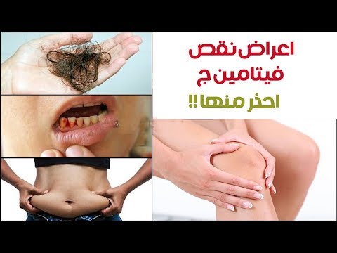هل تعلم أعراض نقص فيتامين ج احذر منها لا تتغافل