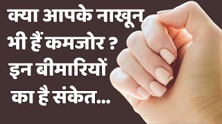 आपके भी नाखून आसानी से टूट जाते हैं? तो जान लें हो सकती हैं इन बीमारियों के शिकार | Boldsky screenshot 1