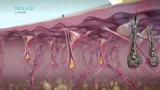 Diolaze The Best and Fastest Laser Hair Removal System