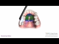 Pendex - Orthodontic Appliance