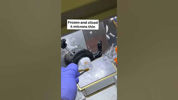 How Mohs surgery works