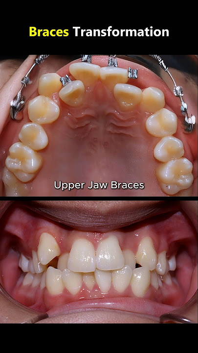 20 months braces ( upper jaw) #dentist #braces #orthodontist