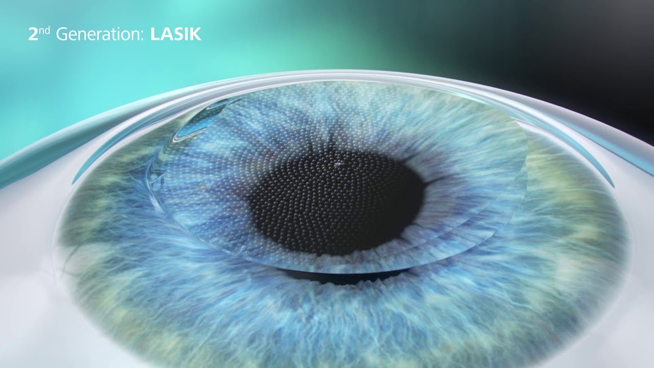 3 Generatons of Laser Vision Correction - YouTube